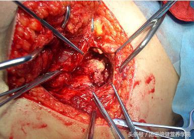 治骨刺的偏方,治疗骨刺偏方大全