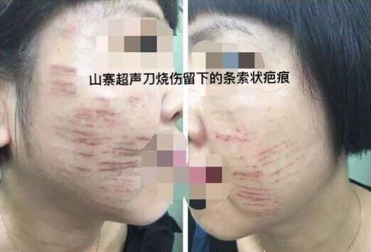 超声刀美容危害，正版超声刀与山寨超声刀的区别