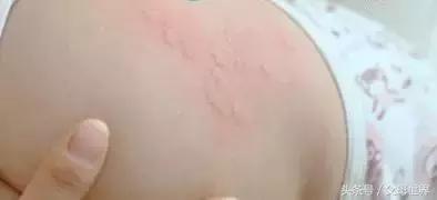 蛀牙会导致面瘫吗,蛀牙会引起偏头痛吗