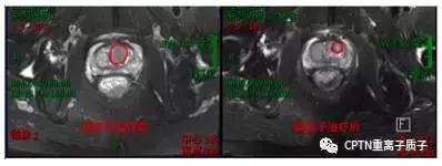 目前质子重离子治疗,2020年中国质子重离子有哪些医院