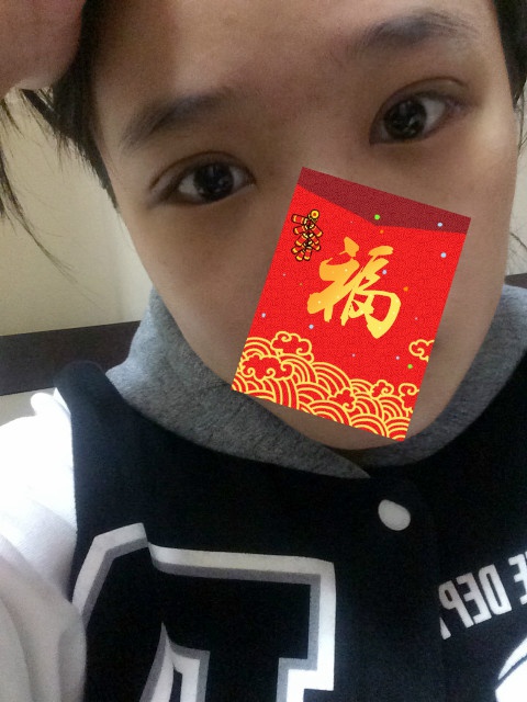 全切双眼皮20天了还一大一小,全切双眼皮的第二个月不来大姨妈