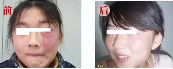 女儿有红胎记，妈妈是这样做的！