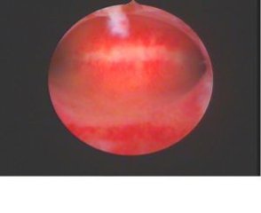 人流术后为什么月经量少,人流术后月经变少是粘连吗