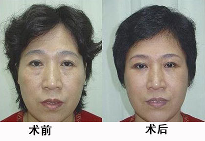 超声刀美容危害，正版超声刀与山寨超声刀的区别