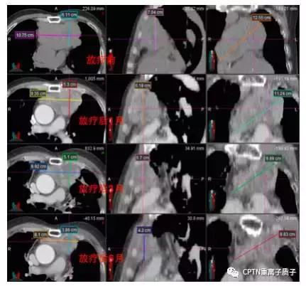 目前质子重离子治疗,2020年中国质子重离子有哪些医院