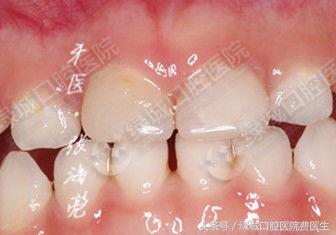 乳前牙透明冠修复视频,乳前牙残根修复