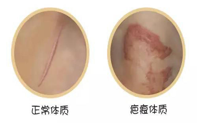 剖腹产伤疤有点红怎么办,剖腹产伤疤硬硬的咋办