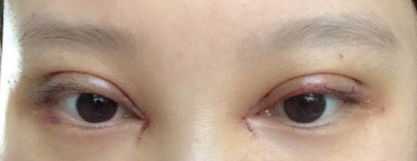 不认识的人看到我，完全看不出来做过双眼皮
