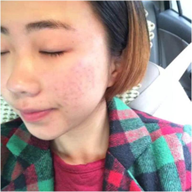 长痘痘黑头粉刺关注什么,青春期脸上长痘痘饮食关注什么