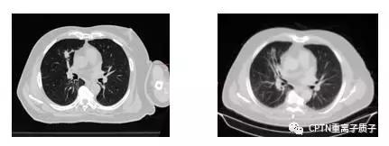 目前质子重离子治疗,2020年中国质子重离子有哪些医院