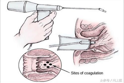 痔疮不管它有什么后果,痔疮患者需要了解的事