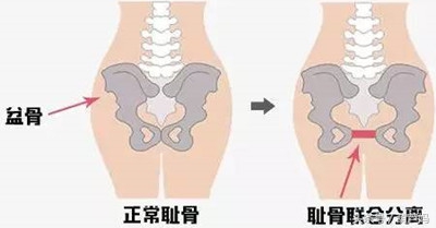 怀孕了才知道冷暖自知,怀孕耻骨痛让老公知道