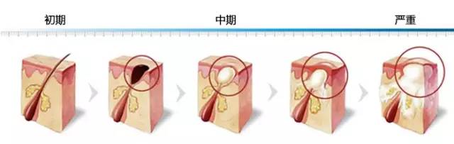 挤痘痘出来的白色东西很臭,挤痘痘出来的白色东西是什么