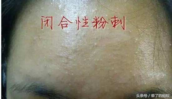 脸上黑头粉刺闭口怎么去除,怎样快速去除脸上的痘痘粉刺