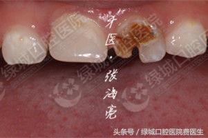 乳前牙透明冠修复视频,乳前牙残根修复