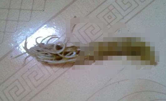 准妈妈实用技能：如何判断宝宝得了蛔虫病附治疗方式