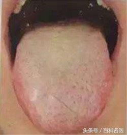 舌苔变黑是得了重病吗,舌苔发黑是大病前兆吗