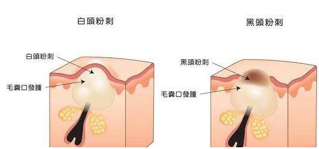 换季疯狂长痘为什么,为什么一到换季皮肤就长痒痘