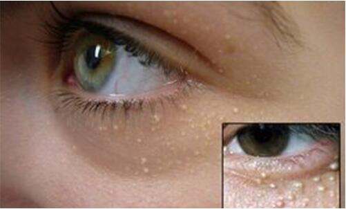 长脂肪粒是皮肤屏障受损吗,长脂肪粒是因为胖吗