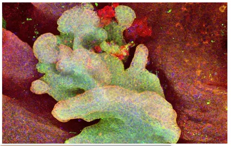 胸腺瘤第8版分期指南,内科学霸笔记
