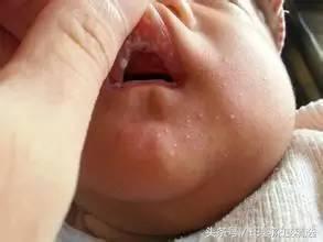 宝宝鹅口疮用制霉素片后吐奶,宝宝得了鹅口疮会导致干呕吗