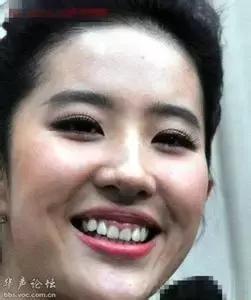 表情纹严重怎么去除,有几个方法处理抬头纹