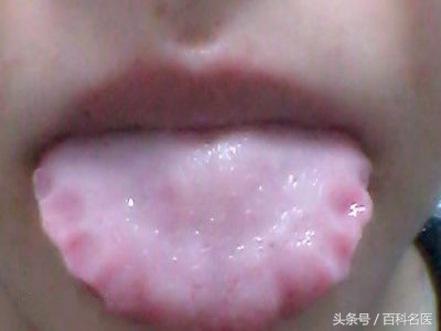 舌苔变黑是得了重病吗,舌苔发黑是大病前兆吗