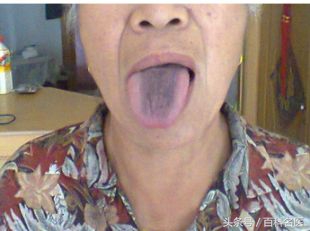 舌苔变黑是得了重病吗,舌苔发黑是大病前兆吗