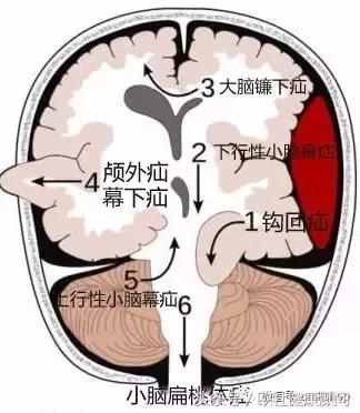 脑卒中脑出血病人的后期康复过程,脑梗死合并脑出血治疗指南最新