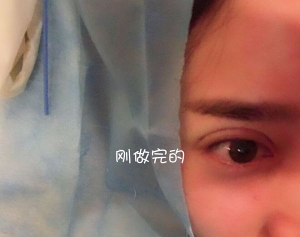 鼓起勇气做了个双眼皮,鼓起勇气做了医美