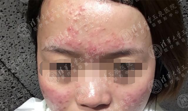 换季疯狂长痘为什么,为什么一到换季皮肤就长痒痘