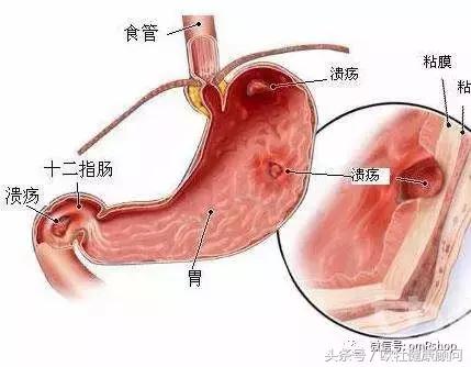 脑卒中脑出血病人的后期康复过程,脑梗死合并脑出血治疗指南最新