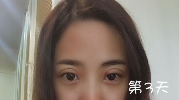 鼓起勇气做了个双眼皮,鼓起勇气做了医美