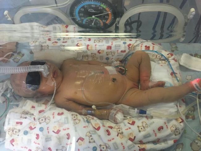 新生儿腹膜透析穿刺,交大一附院透析中心