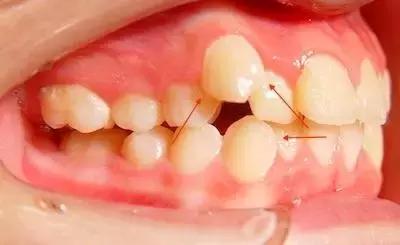 牙齿老是卡菜卡肉怎么办,牙齿卡肉导致牙痛