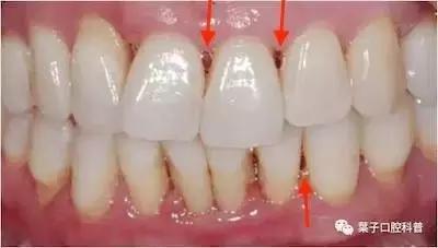 牙齿老是卡菜卡肉怎么办,牙齿卡肉导致牙痛