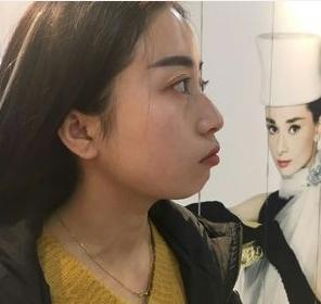 下巴后缩垫下巴案例,垫了下巴膨体皮肤松弛严重