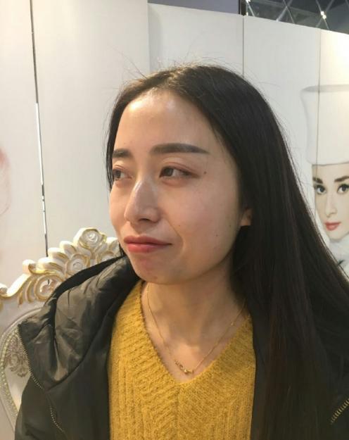 下巴后缩垫下巴案例,垫了下巴膨体皮肤松弛严重