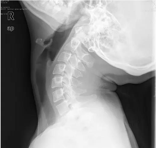 玩手机颈椎保护神器儿童,儿童玩手机颈椎弯曲如何康复