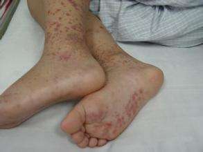 过敏性紫癜的症状,过敏性紫癜性肾炎的诊治