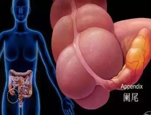 孕妇阑尾炎疼痛位置图,孕妇遭遇阑尾炎该怎么办