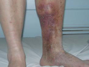 治疗静脉曲张，多花钱的五大原因！