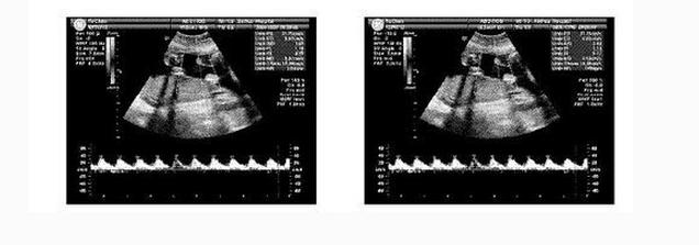 一分钟看懂b超图,一分钟看b超