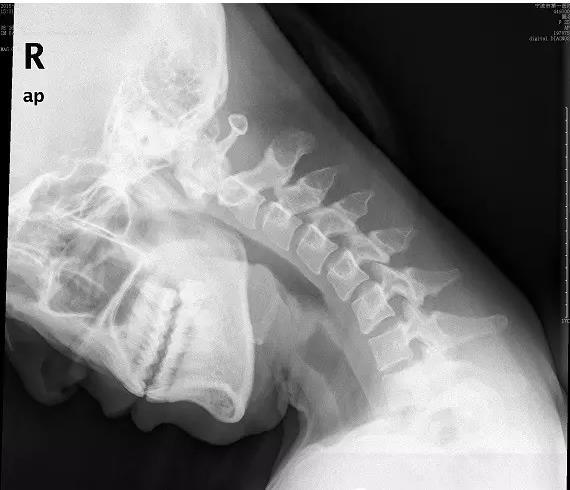 玩手机颈椎保护神器儿童,儿童玩手机颈椎弯曲如何康复