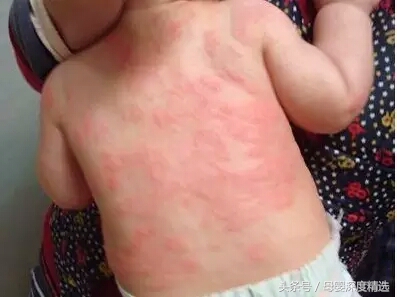 婴儿面部湿疹怎么护理效果最好,宝宝湿疹流脓结痂的部分怎么护理