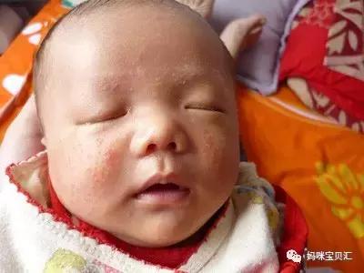 孩子湿疹反复有必要忌口吗,宝宝经常湿疹吃什么维生素