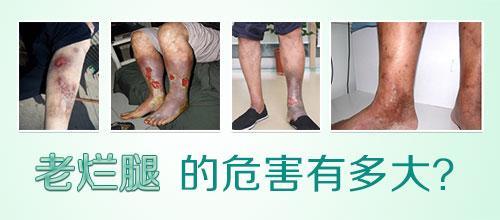 老烂腿治好后图片,得了老烂腿如何治疗