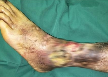 老烂腿治好后图片,得了老烂腿如何治疗