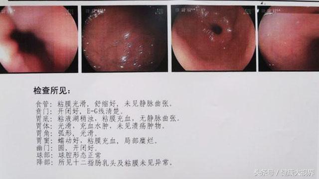 萎缩性胃炎的8个药方,萎缩性胃炎的神奇逆转