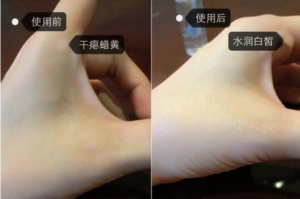 玻尿酸多少钱一支填充,玻尿酸多少钱一瓶图片